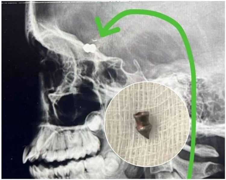 Criança é alvejada com tiro na cabeça em brincadeira de Páscoa | Foto: Reprodução/jhnoticias.com.br